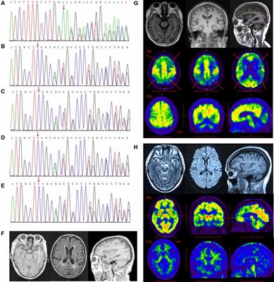 Analyses Mutations in GSN, CST3, TTR, and ITM2B Genes in Chinese Patients With Alzheimer’s Disease